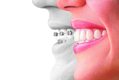 Port Washington Invisalign